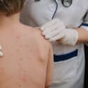 Chickenpox is a viral infection that mostly affects children, but you can get it at any age