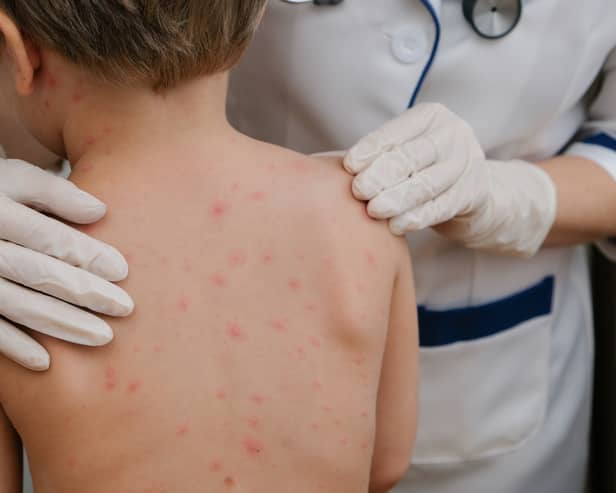 Chickenpox is a viral infection that mostly affects children, but you can get it at any age