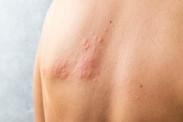 You should get advice from 111 as soon as possible if you think you have shingles