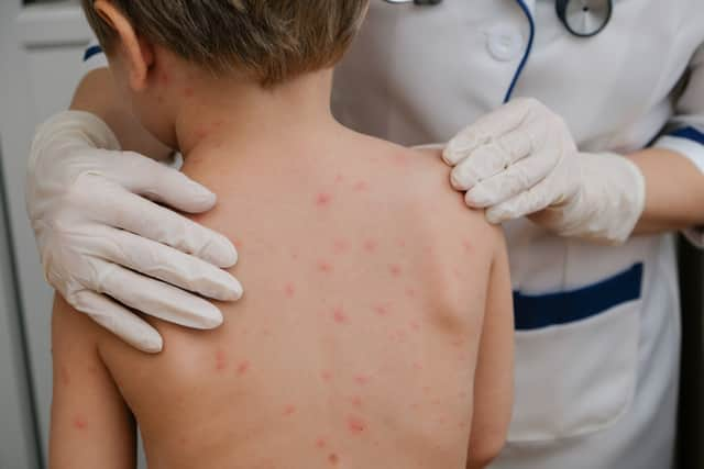 Chickenpox is a viral infection that mostly affects children, although you can get it at any age