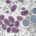Monkeypox pathogen. Credit: UKHS