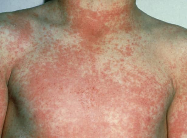 <p>After 12 to 48 hours the characteristic fine red rash of scarlet fever develops</p>