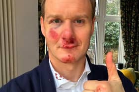 Dan Walker says he has no memory of the crash which left him bloody and bruised. Credit: Dan Walker