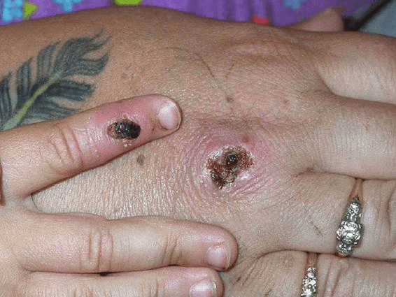 Monkeypox is a rare disease caused by infection with the monkeypox virus (Photo: CDC/Getty Images)