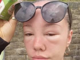 A Stockport woman’s eyes swelled over two days after she experienced sun poisoning.