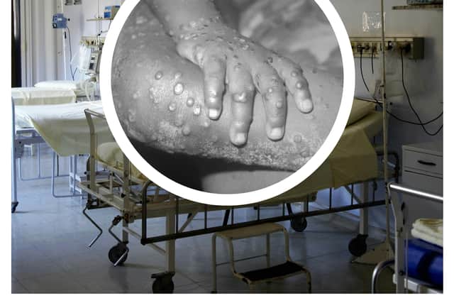 The WHO has declared a global health emergency over a mpox outbreak. (Photo: Pixabay, CDC/Getty Images)