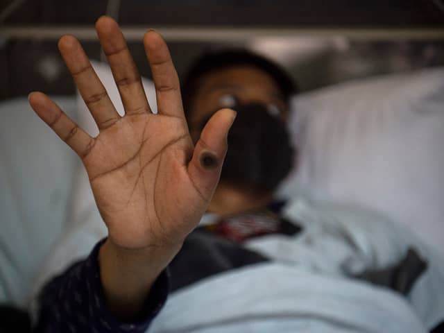 The WHO has declared a global health emergency over an outbreak of mpox in Africa. (Photo: ERNESTO BENAVIDES/AFP via Getty Images)
