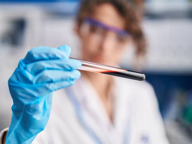 The new blood test can remove barriers to an early diagnosis