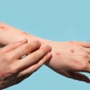 A fifth UK case of mpox Clade Ib has been found in Leeds