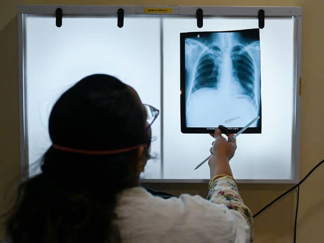 Tuberculosis (TB) cases in England have increased by 13%.