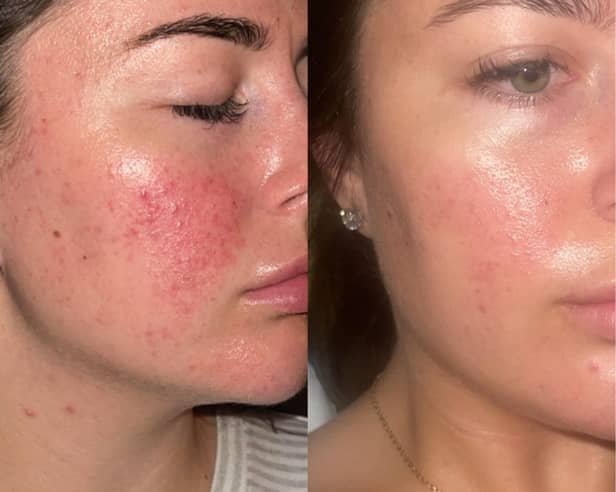 These are before and after images of Jamie, another 47 Skin user
