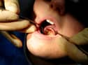 Child tooth extractions increase.