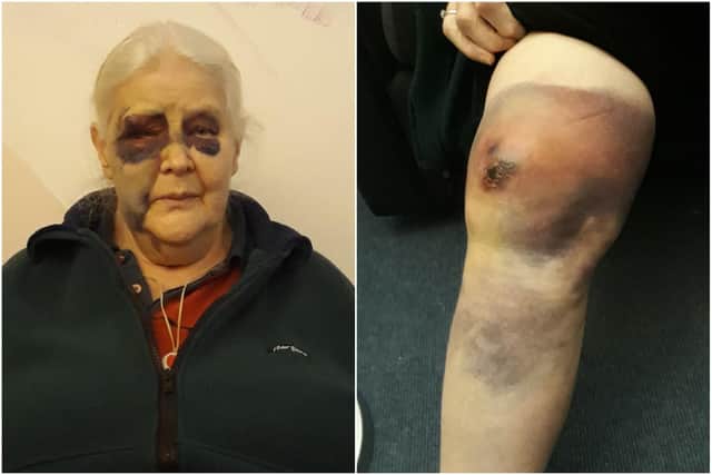 Northumbria Police has asked people to look at Ida Brown's injuries and think about the impact of the attack on her if they know who carried out the assault.