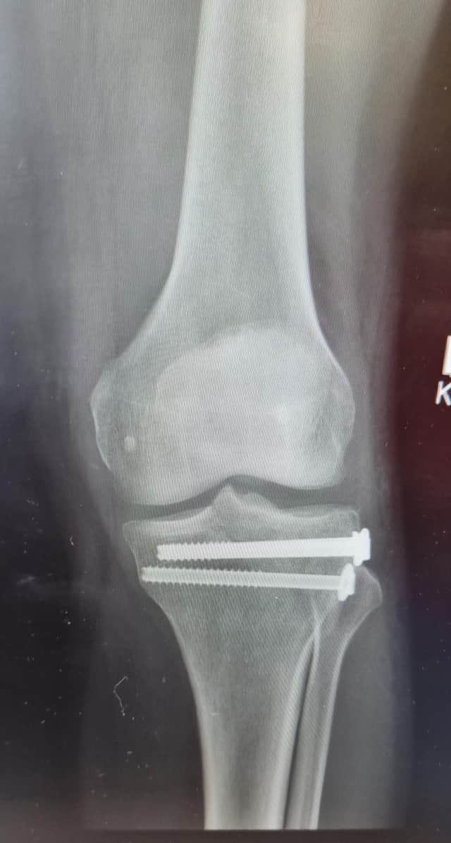 An x-ray showing Mark's broken knee.