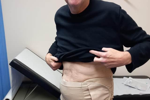 Ed Waugh after having his stoma fitted.