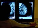 Action call over cancer figures.