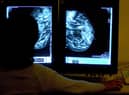 Action call over cancer figures.
