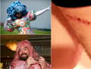 Colin Burgin-Plews who has fought back from an operation to remove skin cancer.