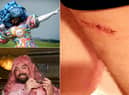 Colin Burgin-Plews who has fought back from an operation to remove skin cancer.