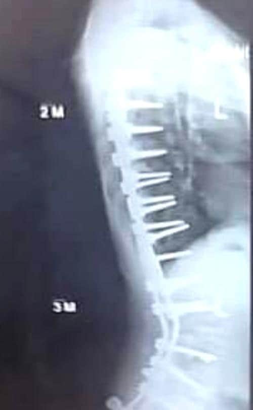 Lauren's spine after she had surgery.
