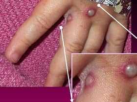 In this Centers for Disease Control and Prevention handout graphic, from 2003, symptoms of one of the first known cases of the monkeypox virus are shown on a patient's.(Photo: CDC/Getty Images)
