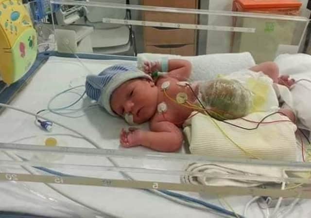 Jack had surgery at five months old when two hernias were operated on.