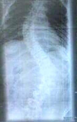 Lauren's spine before she had surgery for her scoliosis.