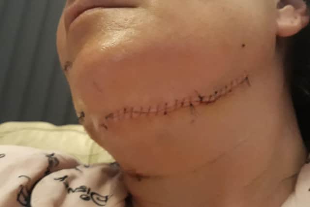 An image released by Northumbria Police of the woman's injuries.