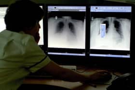 TB is on the increase in South Tyneside