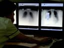 TB is on the increase in South Tyneside