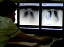 TB is on the increase in South Tyneside
