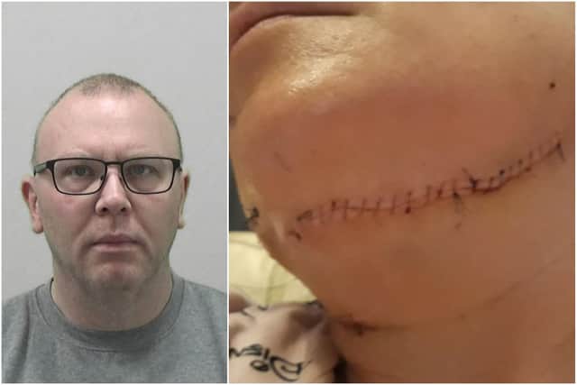 Karl Molyneaux. Right: the injury to the victim's throat which required life-saving surgery. All pictures have been released with the victim's permission