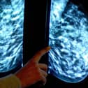 Breast cancer screening fears