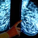 Breast cancer screening fears