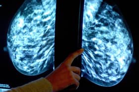Breast cancer screening fears