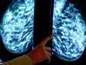 Breast cancer screening fears