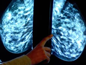 Breast cancer screening fears