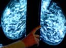 Breast cancer screening fears