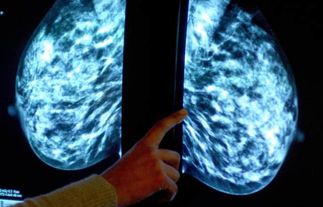 Breast cancer screening fears