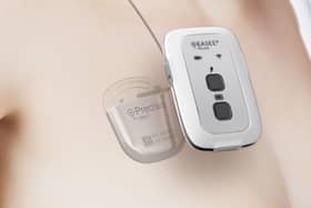 EASEE®  which stands for Epicranial Application of Stimulation Electrodes for Epilepsy, from med-tech company Precisis