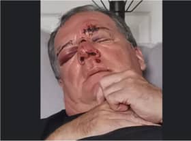 Michael Johnstone after the attack