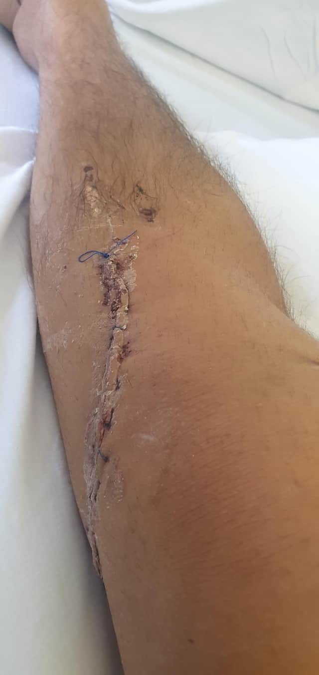Mark's broken leg, post-op.