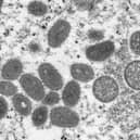 The monkeypox virus.