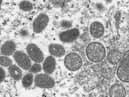 The monkeypox virus.