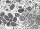 The monkeypox virus.