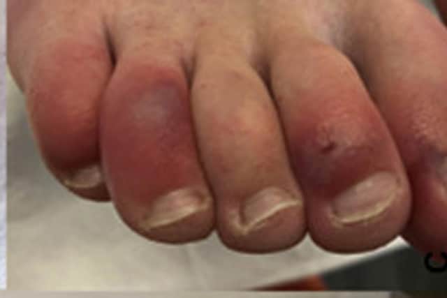 A photo issued by Journal of the American Academy of Dermatology of a person showing a skin symptom known as Covid toes, which sees some patients infected with coronavirus developing swollen and reddened skin for potentially months at a time, scientists have said.
