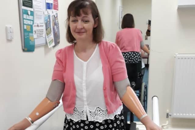 Kathleen's current prosthetic limbs are limited to what they achieve.