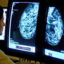 Up to 75 women may have died early following blunders in a breast screening, according to latest estimates.