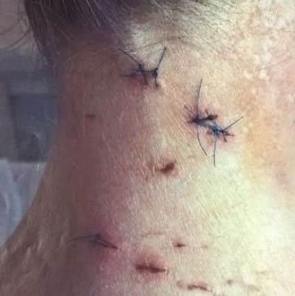 The woman was left with bite marks around her neck.