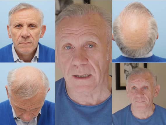 Peter Reid before and after his hair transplant. The 'after' pictures are the middle and bottom right. Pics: Farjo Hair Institute.